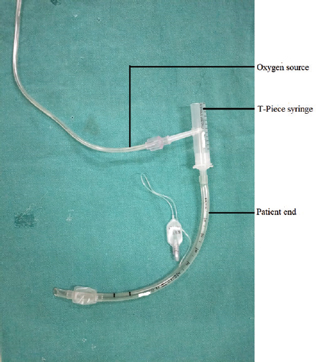 T-piece syringe in the circuit with endotracheal tube at the patient end along with oxygen source.